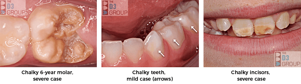 Pic1: 10 yr old front teeth affected by molar hypomin, Pic 2: Extra white spots on molars caused by molar hypomin, Pic 3: 6-year-old crumbly molar caused by molar hypomin